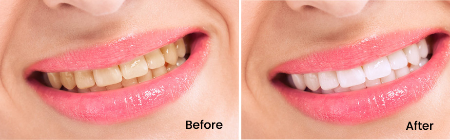 Teeth Whitening Before After