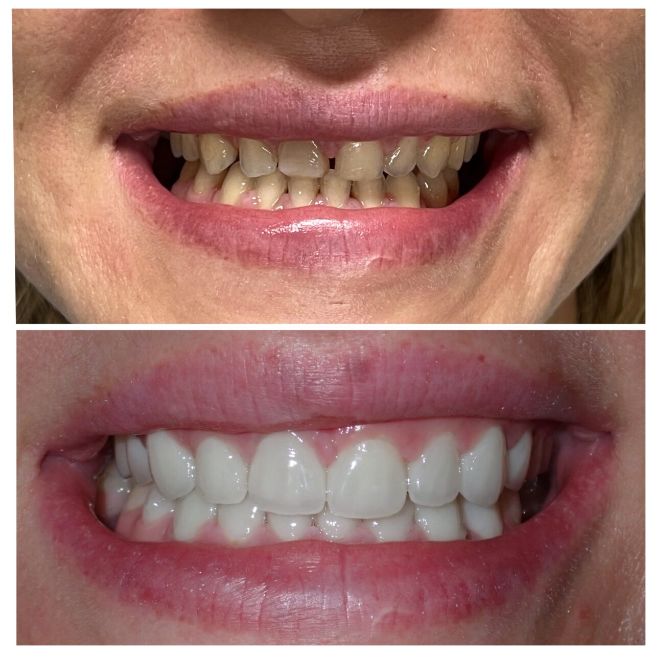 Veneers Perfecting Every Smile