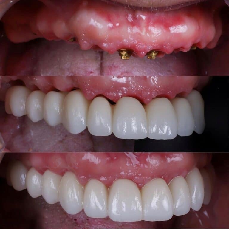 Dental Implant 