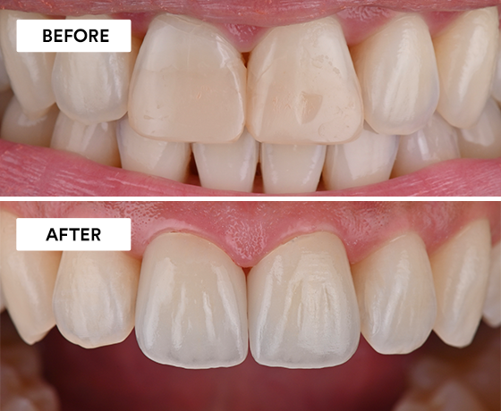 Ceramic Crowns Before After