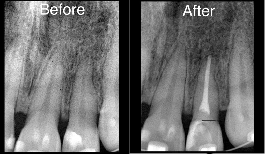 Comparison X Ray Tooth Pre And Post Root Canal Procedure