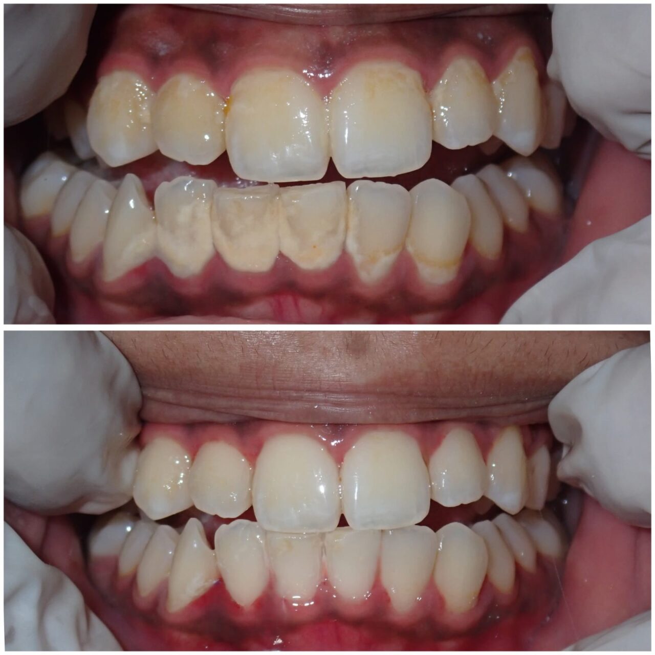 Dental Treatment Pre Post