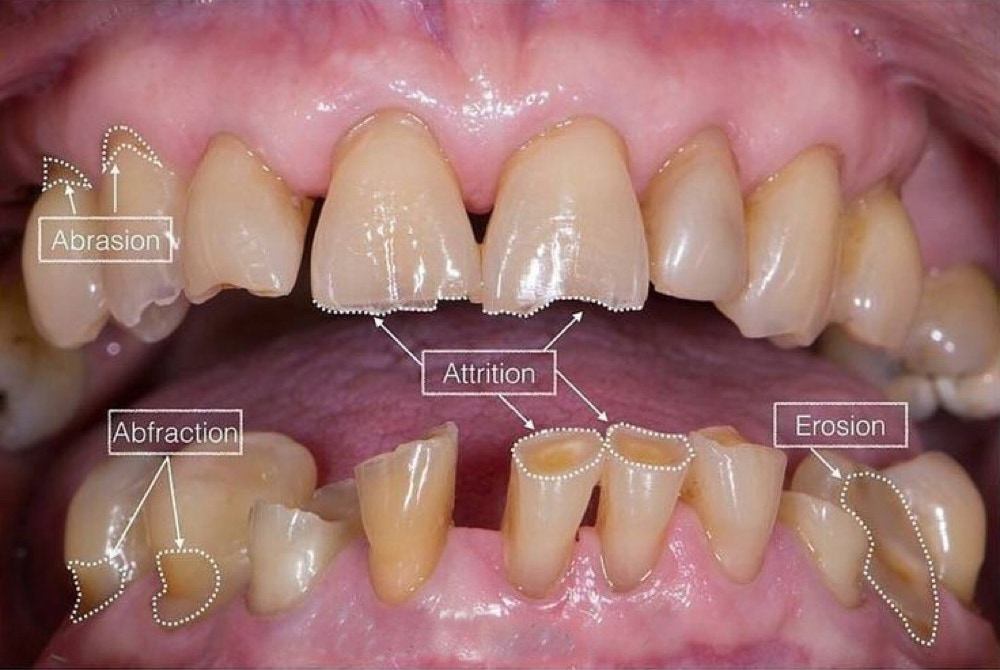 Erosion Abrasion Abfraction Attrition