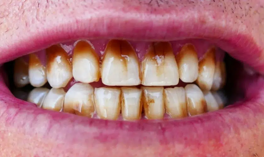 Get Coffee Stains Off Your Teeth With Teeth Whitening