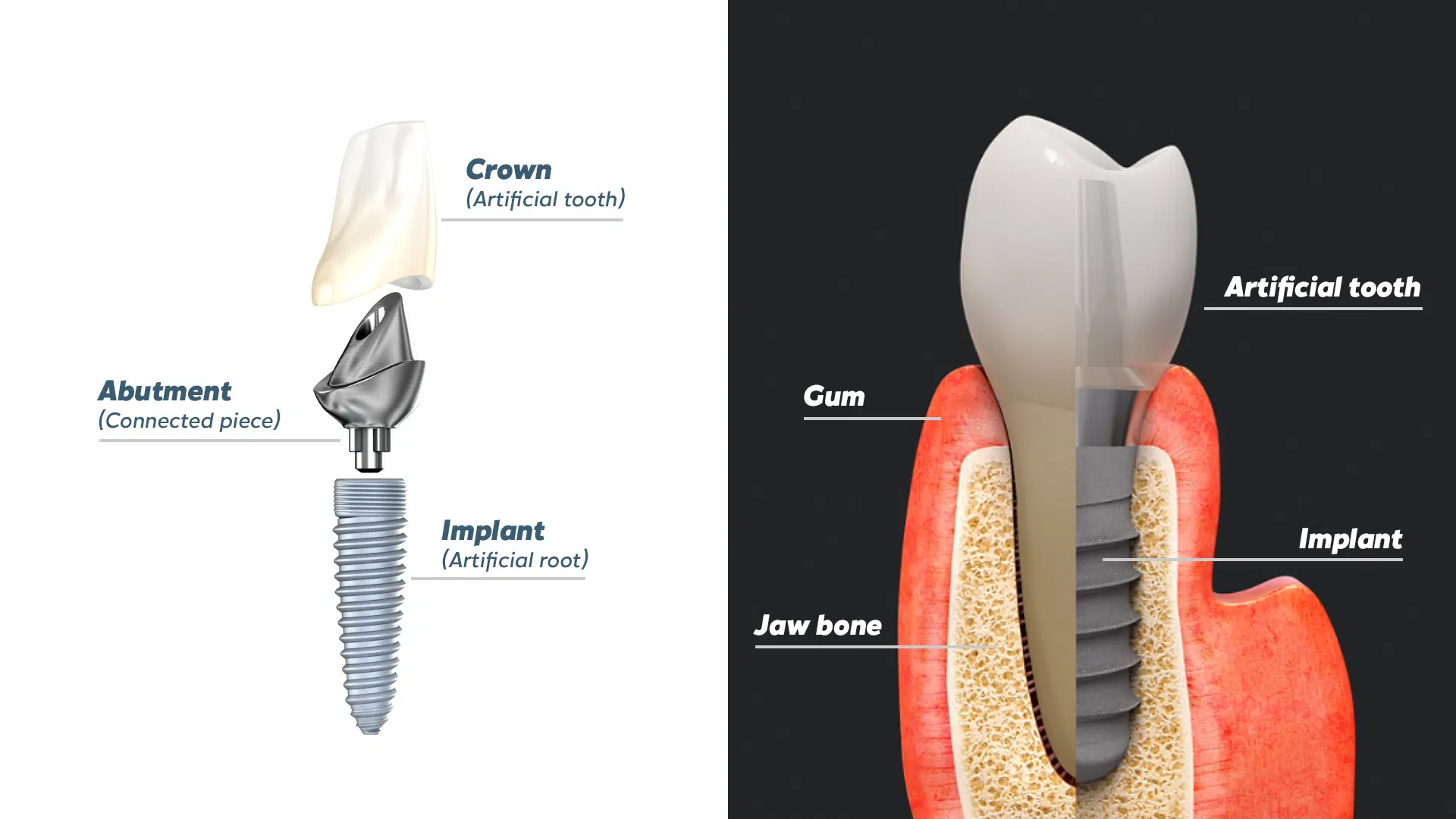 Implant Pose