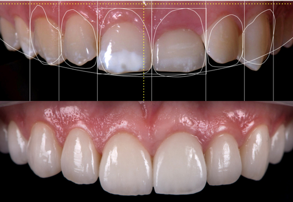 Ceramic Crowns Before After