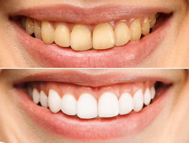 Pre And Post Teeth Whitening