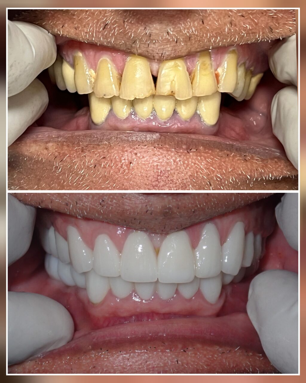 Smile Makeover Treatment Before After