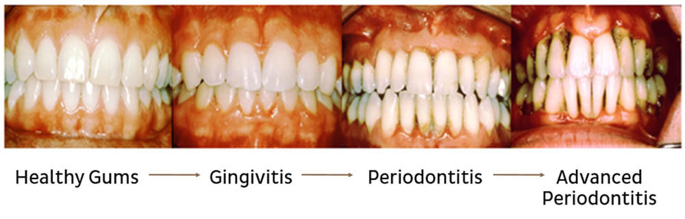 Stages Of Periodontal Disease