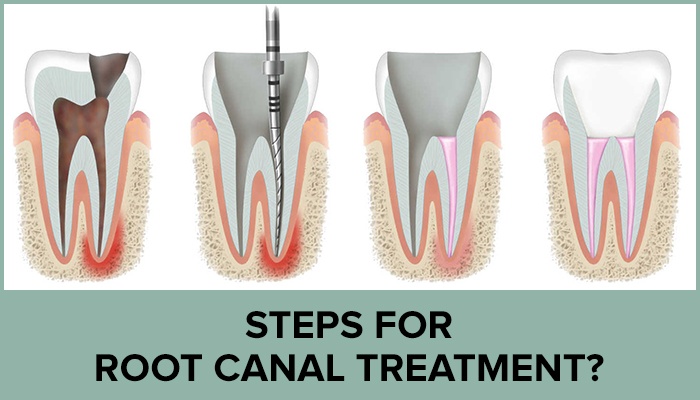 Stages Of Root Canal Treatment