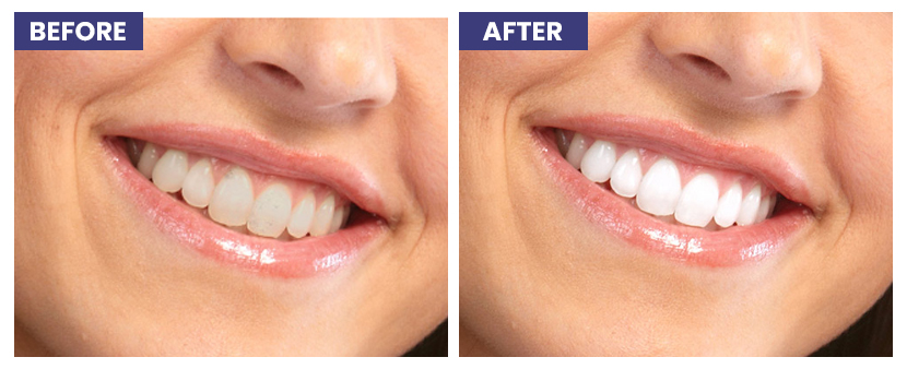 Teeth Whitening Before After