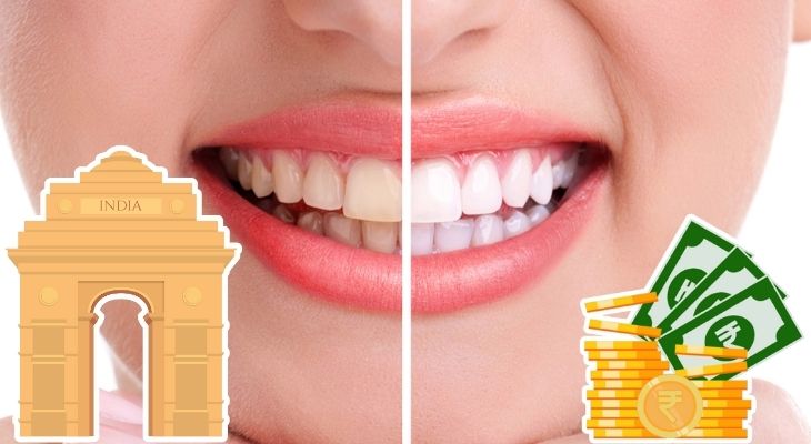 Teeth Whitening Cost In Delhi