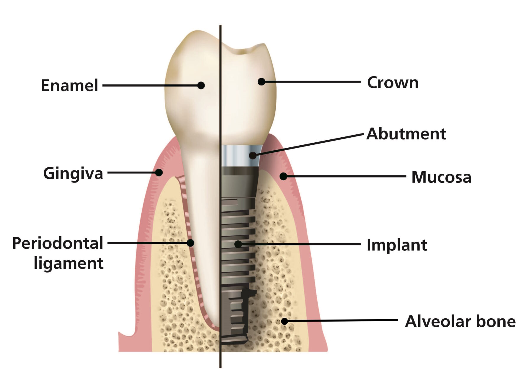 Dental Implant 