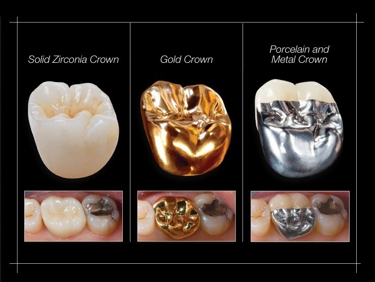 Zirconium Crowns