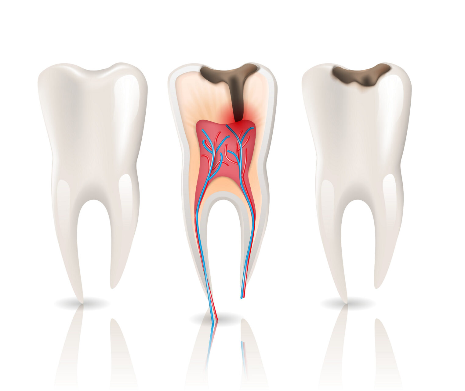 Understanding Root Canal Treatment in Delhi