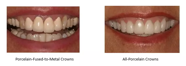 All Porcelain Crowns B A