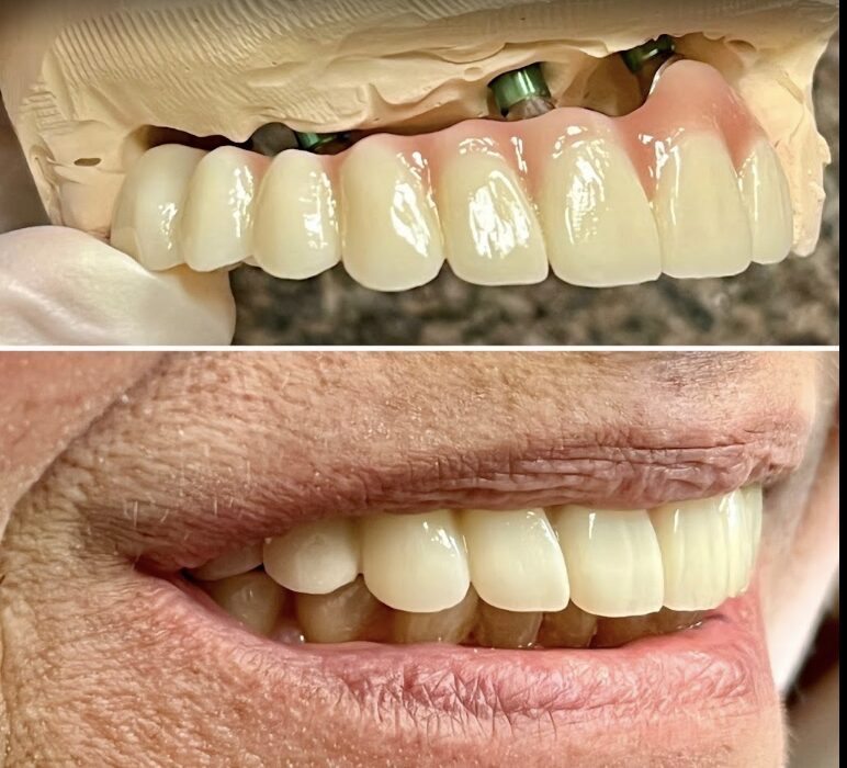 Dental Implants Before After