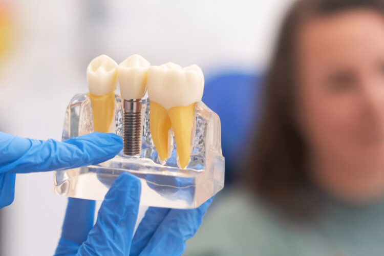 Healthy Habits To Extend Life Of Dental Implants