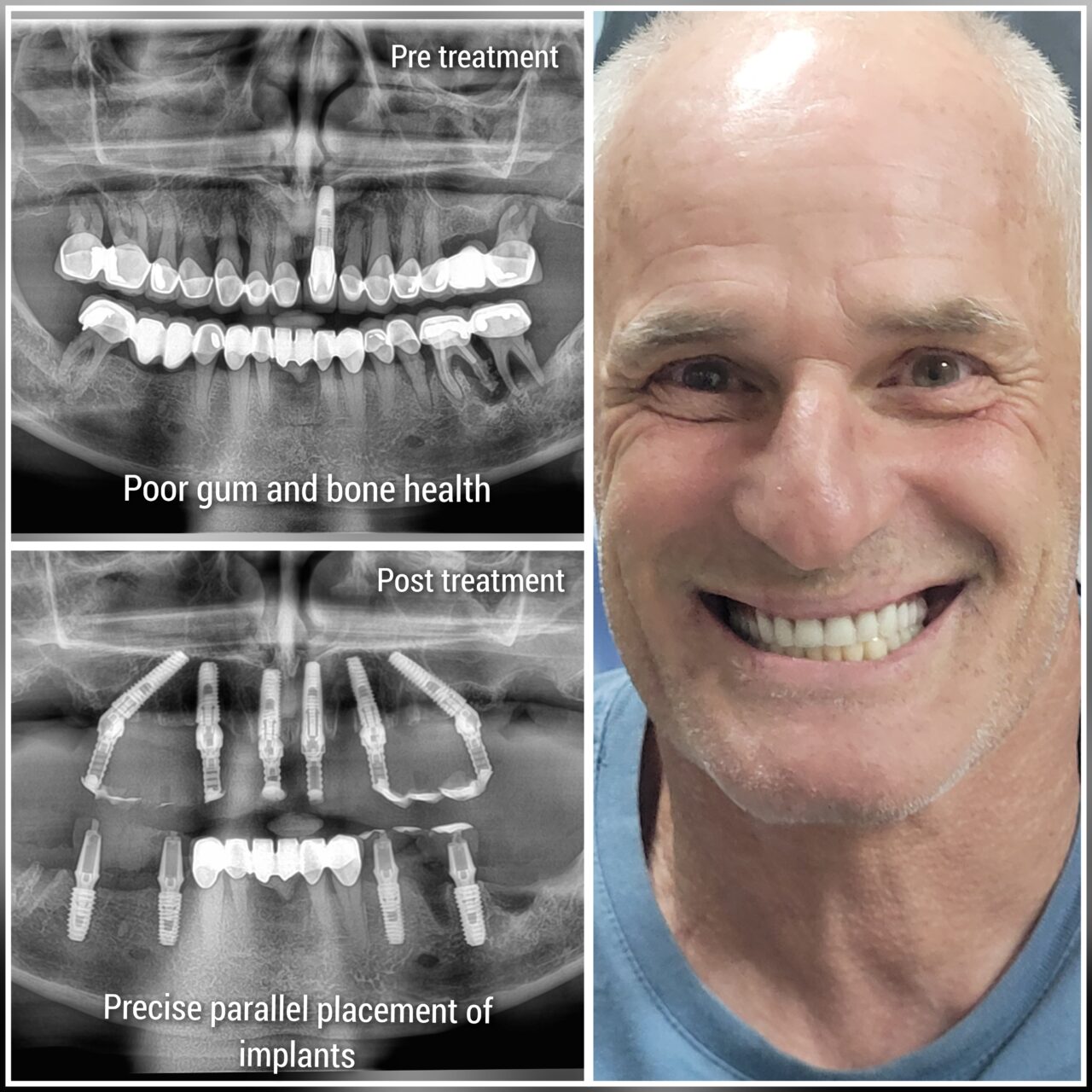 Pre Post Smile Makeover