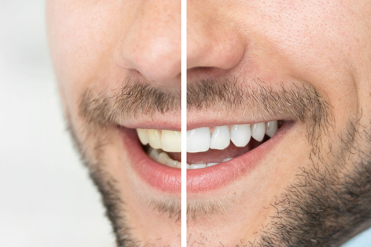 Teeth Whitening For Everyday People