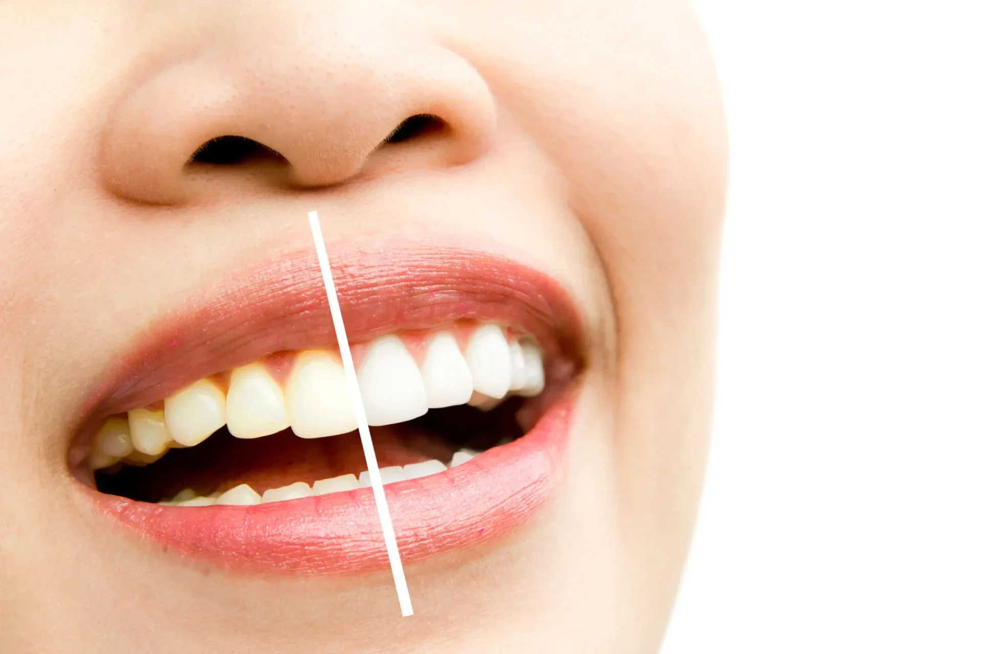 Zoom Teeth Whitening In Delhi