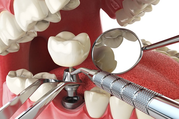 Common Myths About Dental Implants