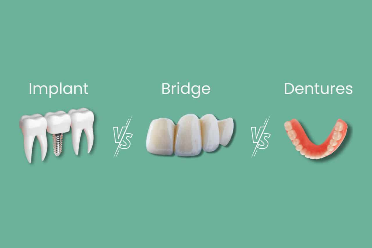 Comparing Dental Implants with Other Options