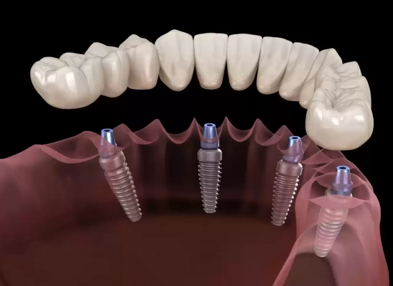 Dental Implant