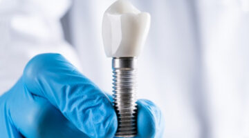 How Dental Implants Can Transform Your Smile