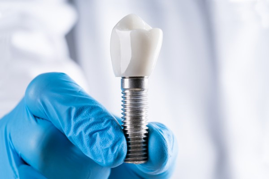 How Dental Implants Can Transform Your Smile