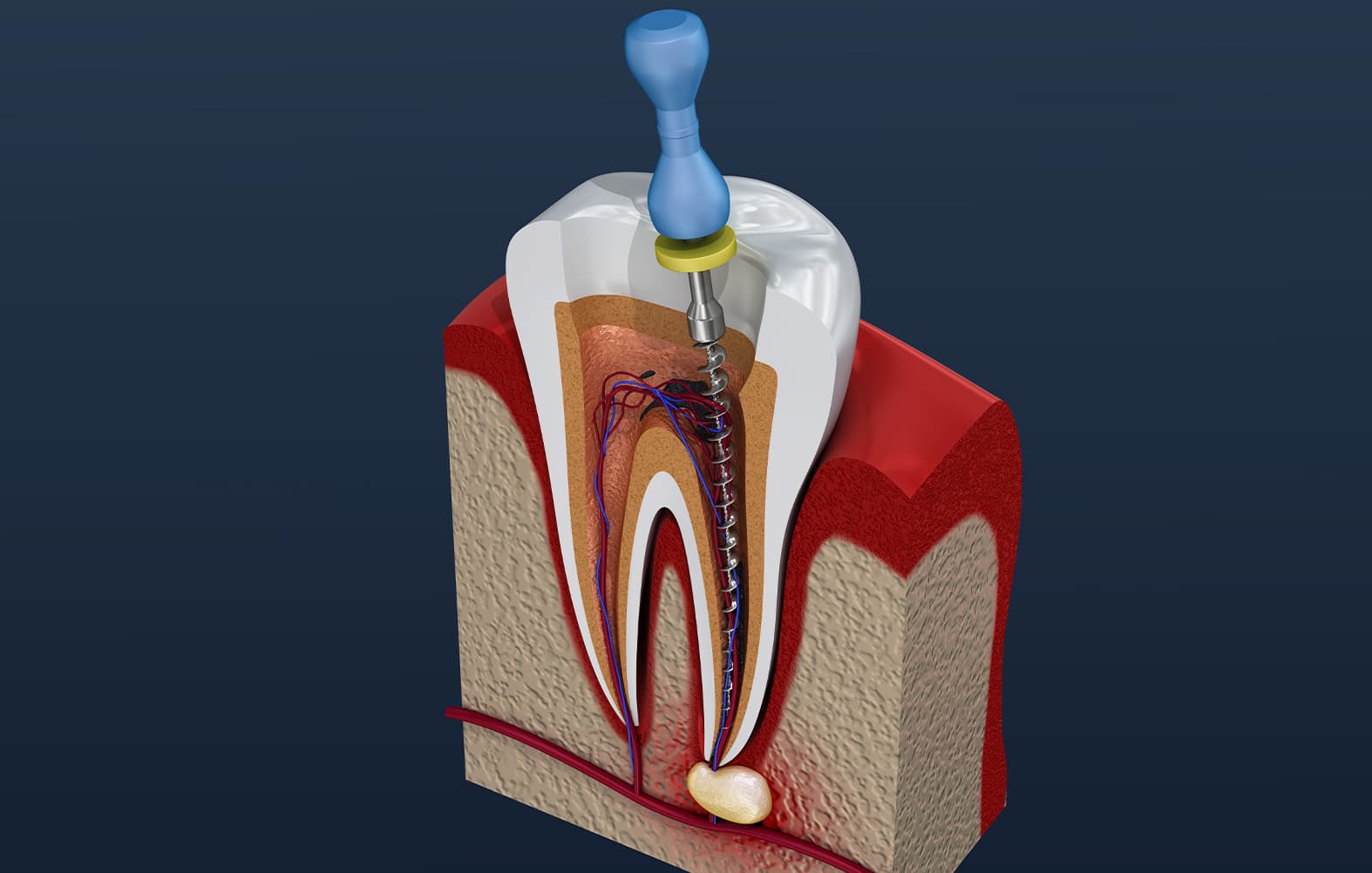 Root Canat Treatment