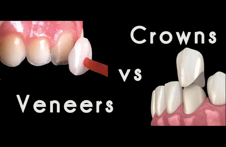 Understanding Custom Veneer And Crowns