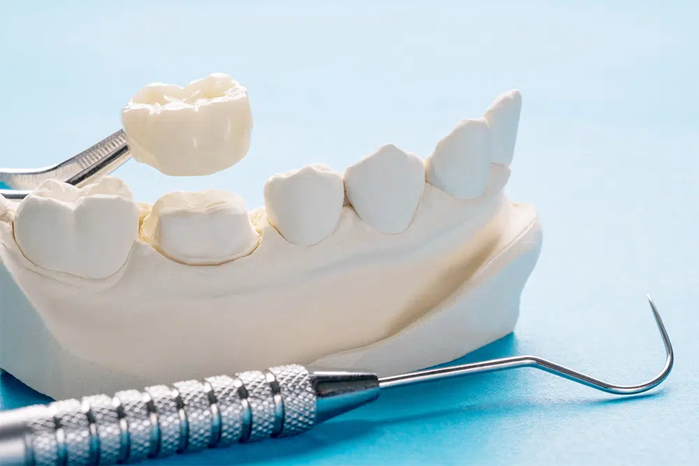 What Are All Ceramic Crowns