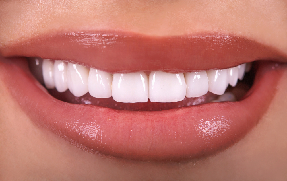 Why Choose Custom Veneers