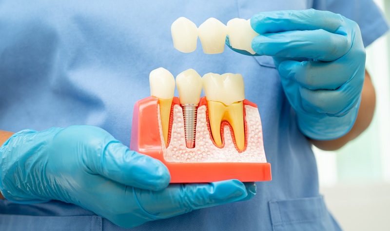 Why Choose Dental Implants