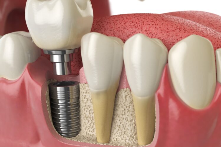 Evolution Of Dental Implants In India