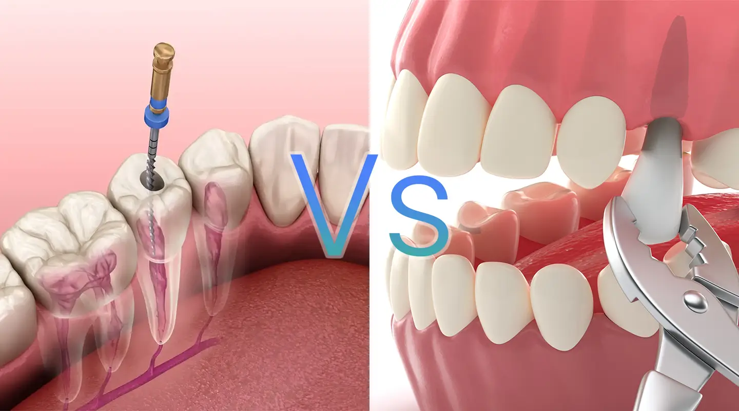 Root Canal Vs Extraction