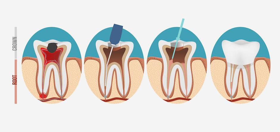 What Is A Root Canal Treatment