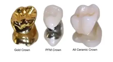 All Ceramic Vs Other Crwon Types Blog Thumbnail