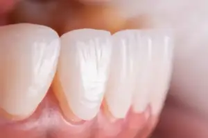 Understanding Crowns And Veneers Blog Thumbnail