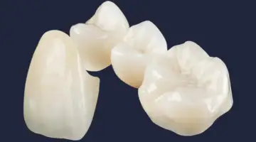What Are All Ceramic Crowns Blog Thumbnail