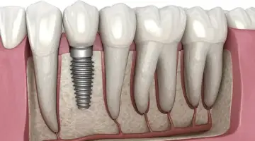 Cost And Value Of Dental Implants In India Blog Thumb
