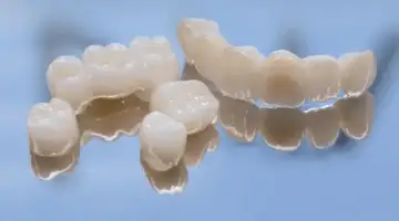 Why Choose All Ceramic Bridges Blog Thumb