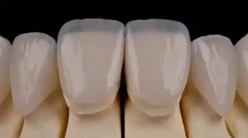 All Ceramic Veneers Blog Thumb
