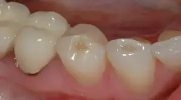 How Teeth Reflect Biological Age Photo