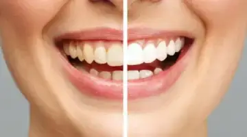 Teeth Whitening Cost Blog Thumb