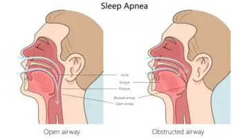 The Tongue And Sleep Apnea Blog Thumb