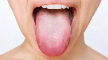 The Tongue As A Diagnostic Map Blog Thumb