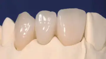 Understanding All Ceramic Bridges Blog Thumb