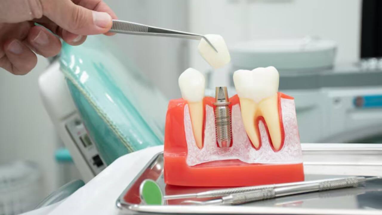 Dental Implants 